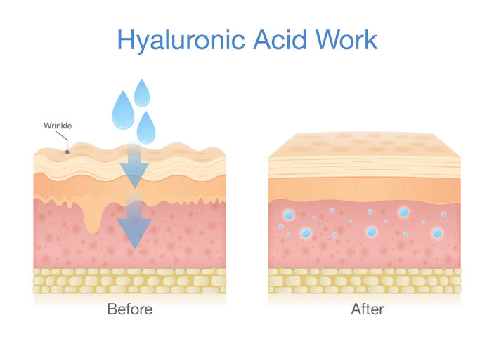 skin layer getting hyaluronic acid increases skin moisture and reduces the appearance of fine lines and wrinkles.