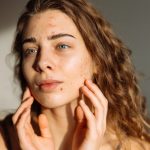 Acne and Acne Scar Care: Gentle Tips for Healthy Skin
