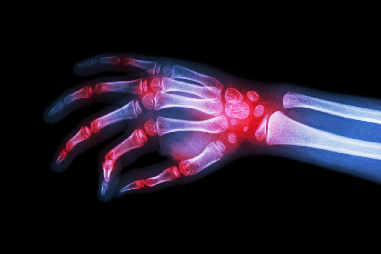 rheumatoid arthritis , gouty arthritis