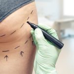 What is Plastic Surgery?